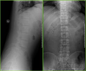 腰椎横突骨折图片 搜狗图片搜索
