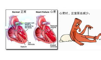 心力衰竭可以治好吗