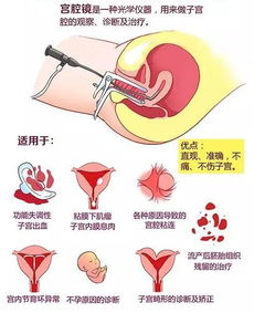 探秘宫腔镜 