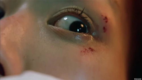女子因车祸左眼受伤,在医院治疗时,却发现左眼能够看到鬼 