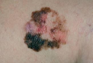 皮肤癌的早期症状，皮肤癌的早期症状有哪些