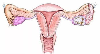 切除一侧输卵管后，还能选择试管助孕吗？