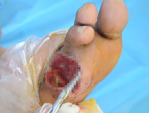 截趾后伤口用骨水泥覆盖治疗无效的案例 原创