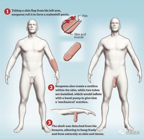 英国男子生殖器官脱落,顶级医生帮他在胳膊上做了个新的 