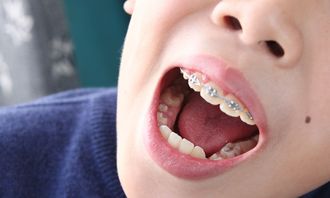 孩子的牙齿护理是一大问题,你是否重视过 作为家长切勿疏忽