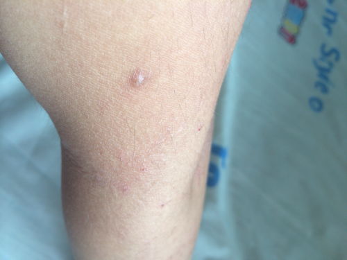 湿毒留下的疤痕,就是西医说的湿疹,有时候还会痒但是皮肤好像有一点发黑,现在很想去掉疤痕,跟毁了手一 