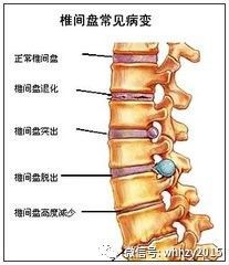 夏天天气炎热适合做腰椎病的手术吗？想找个收费相对实惠的私立医院。