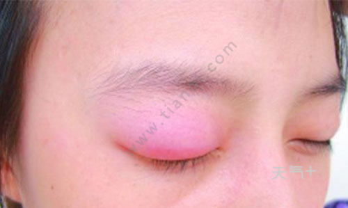 上眼皮肿是什么原因 眼皮肿如何消肿