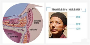 填充泪沟怎么弄好看？填充泪沟最好的方法(填充泪沟用什么方法最好)