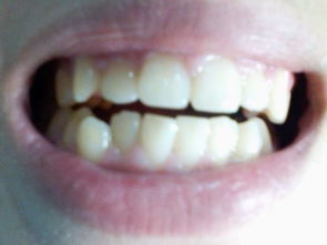 牙齿咬合不正,上牙前突,还有4颗小虎牙,上下各两颗,要怎么治 