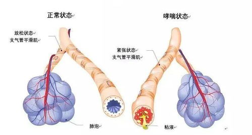 原有哮喘病史晚上胸闷是怎么回事