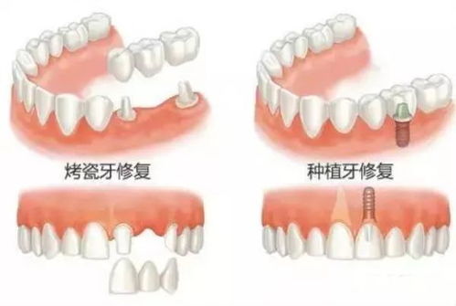 牙齿损伤到什么程度需要做牙冠