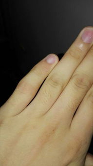 小手指因为打篮球外伤都快半年了还能恢复吗 
