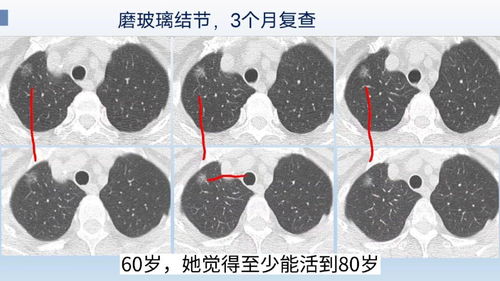 肺结节大于1厘米,要手术吗 可以参考这个病例,微浸润腺癌 