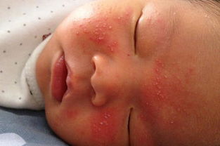 婴儿反复性湿疹怎么治疗