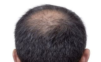脱发 秃顶 M型脱发 脂溢性脱发 如何彻底解决脱发 