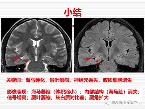 海马硬化的影像诊断