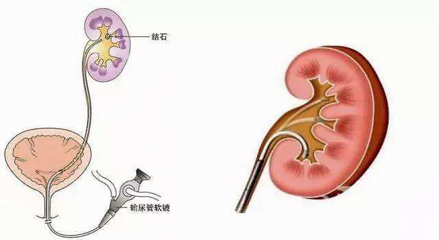 肾结石也是分类的,你知道为什么肾实质结石这种的比较罕见吗