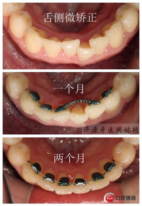 比隐适美更美的舌侧微矫正,悄悄排齐,悄悄变美