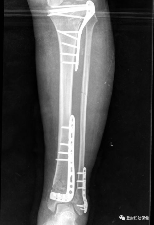 胫骨骨折钢板螺丝钉内固定术 文章阅读中心 急不急图文 Jpjww Com