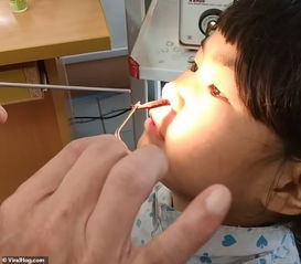 小女孩因鼻子不舒服去检查,医生竟从她鼻子里取出3英寸长的虫子