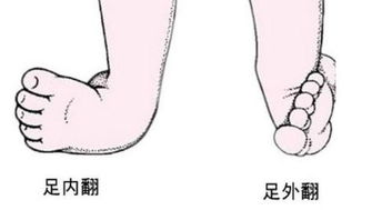 足内翻 足外翻区别 图片欣赏中心 急不急图文 Jpjww Com