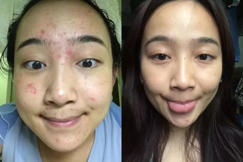 日本爆卖 堪称护肤界 戴森 的面膜仪,随时在家做SPA 告别问题肌肤