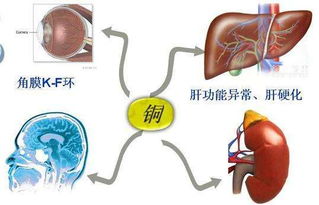 肝豆状核变性有哪些做好的治疗方法