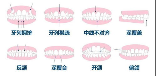 牙医,同样是矫正,为什么有的人时间短,有的人时间长