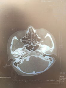 面部骨折需要手术吗 