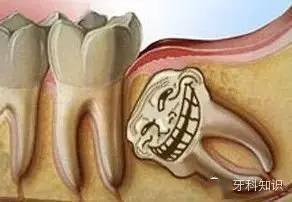 什么样的智齿一定要拔 专业牙医告诉您