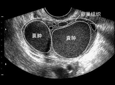 沙井张女士治愈卵巢巧克力囊肿喜得孩子