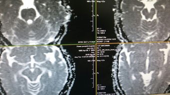 女 36岁,频发晕厥8个月,一天最多达几十次上百次 脑干病变 影像医学和核医学讨论版 