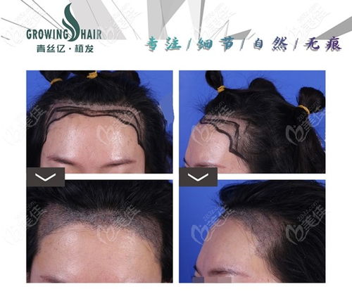 m型发际线植发500单位有多大面积 种头发手术得多少钱
