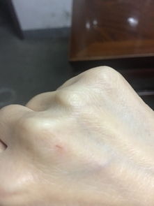 早上起来发现手上有一个伤口,当时不太看得出,这是第二天的照片,会是老鼠咬的吗 