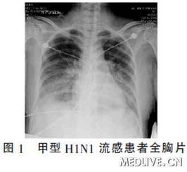 是不是甲型 流感？