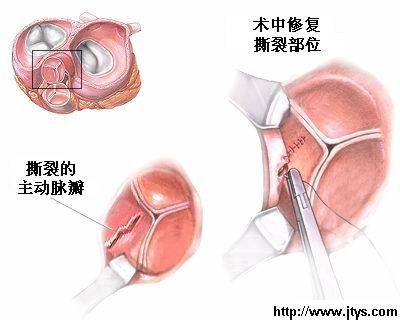 心血管外科手术.心脏瓣膜手术.手术过程