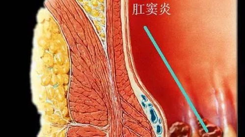 肛肠疾病的 发源地 ,不容忽视的肛窦炎