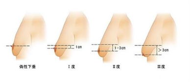 乳房下垂如何治疗(乳房下垂如何治疗)