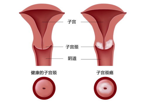 请问：hpv潜伏期是多久？大概什么时候可以发现？在成都哪块治疗效果更好的》？要几多资人民币啊》？