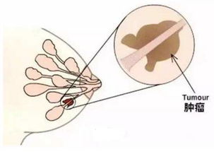 乳腺增生 囊肿和结节,究竟有何区别 