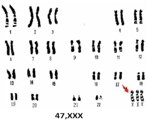 怀孕12周 6,无创plus检测出47xxx,预约了做穿刺,请问穿刺翻盘的机会大么