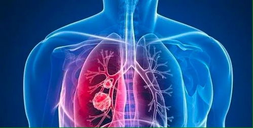肺结节是怎么形成的(磨玻璃肺结节是怎么形成的)