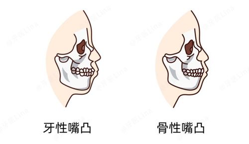 正颌只不过是拼凑积木一样,可以为所欲为 必知的正畸正颌问题