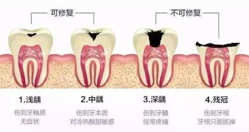 牙齿明明不疼,为什么牙医要我做根管治疗