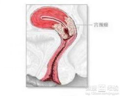 宫颈癌褐色分泌物图片，阴道出现褐色分泌物就一定是宫颈癌吗