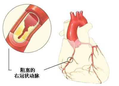 冠心病能治好吗 得了冠心病严重吗 最佳治疗策略是什么