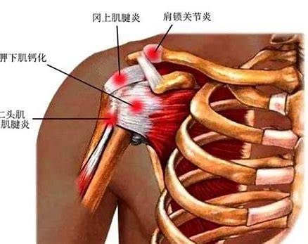 肩周炎Frozen shoulder 佛山顺德复健