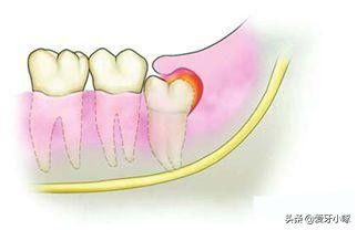 当一次拔了四颗智齿后是怎么回事,关于一次拔完四颗智齿的新消息 多特软件资讯 