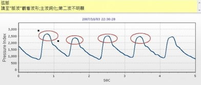 弦脉的脉象 